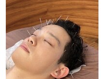 あおなみ はり きゅう整骨院/新メニューの頭皮鍼です♪
