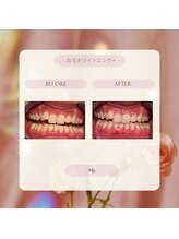 プラスビーセルフ(+b self)/ホワイトニングビフォーアフター