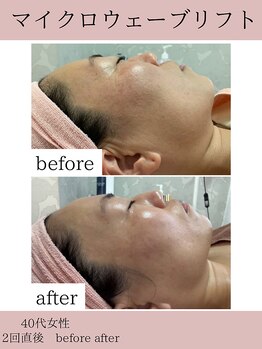 ココ(COCO)/マイクロウェーブリフト/小顔