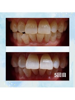 ウィズザホワイト(WITH THE WHITE)/高濃度ジェル使用