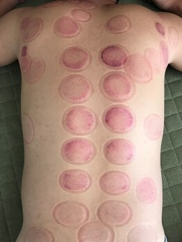 トトン(toton)/カッピングの跡