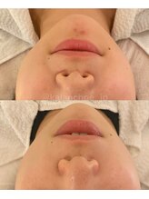 カランコエ(KALANCHOE)/目立ちやすい顎の跡にも