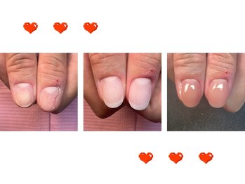 キューティー 錦糸町店(Cutee)/深爪、噛み爪矯正コース