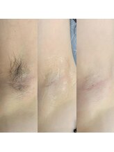 エミリー(Emily)/脱毛