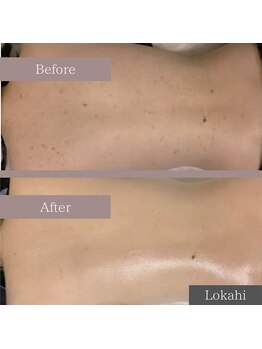 ロカヒ(Lokahi)/#水光肌ピール#背中#美肌ケア