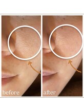 リエイト(Re:eight)/プラズマ＋ハイドラ