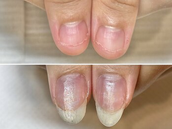 グラシュータン(gracieux temps)/【深爪矯正13000円】