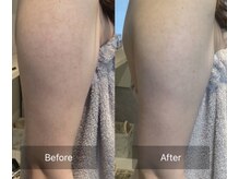 シェリル 松江店(CHARIRE)/ハーブピーリング/毛孔性苔癬