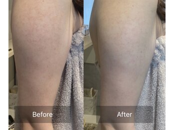 シェリル 松江店(CHARIRE)/ハーブピーリング/毛孔性苔癬