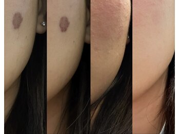 エステサロン マーヴェラス/最新シミケ【ホワイトラボ】