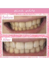 エクシアホワイトニング 戸田公園店/お客様のビフォーアフター