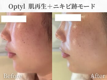 芯美 恵比寿店(shinbi)/オプティル/赤み鎮静