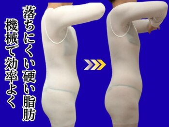 ビエル 掛川店(Bielle)の写真/【背中のハミ肉・段々お腹・柔らか二の腕】落ちにくい頑固な脂肪に！諦める前にプロの本格ケアで徹底撃退★
