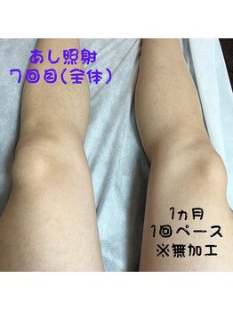 フェリッセ(FELISSE)/あし脱毛 照射7回目【M様】