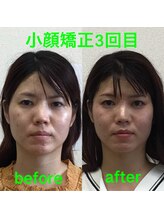 オズ六本木/滑らかなフェイスラインの小顔へ