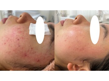 ミュー 春日井店(mieux)/◆肌質改善例