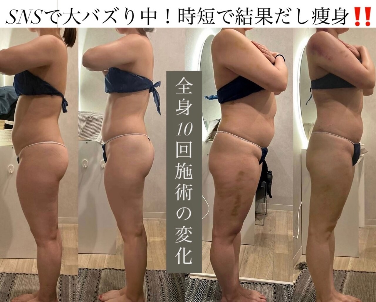 【大幅値下げ】リファインシュール 痩身エステ ソンリッサビエン(sonrisabien)｜ホットペッパービューティー