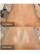 シェリル 松江店(CHARIRE)/ハーブピーリング/フェイシャル