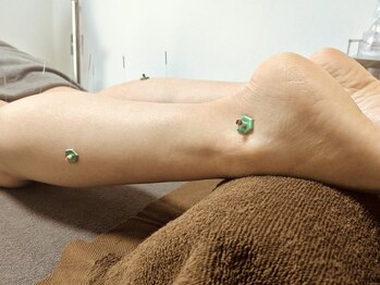 鍼灸マッサージ院りあん 片倉町/鍼とお灸で根本改善