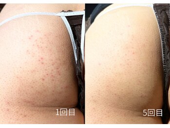 エミルカ 日の出平井店(EMILUCA)/お尻のブツブツにもハーブケア