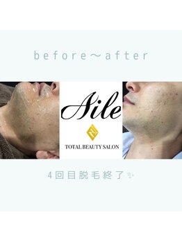 エル(AILE)/before~after