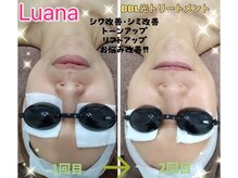 ルアナ(Luana)/BBL光トリートメント