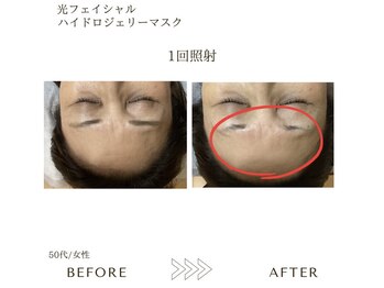 サロン エイトミー(salon 83)/光フェイシャル+ジェリーマスク