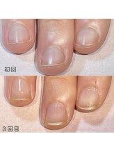 ココデネイル(cocode nail)/悩み：爪噛み（20代後半)その２