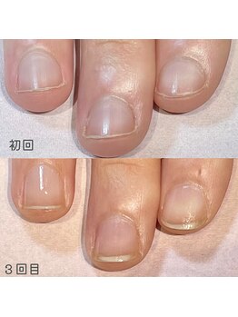 ココデネイル(cocode nail)/悩み:爪噛み(20代後半)その2
