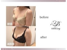 ベルビューティー(belle beauty)/バストアップ◇症例◇