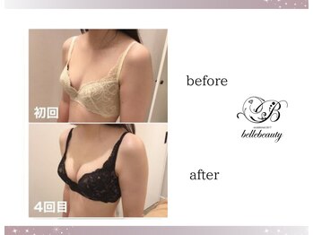 ベルビューティー(belle beauty)/バストアップ◇症例◇