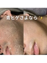 アムリリー 南草津店(AMRILY)/メンズ脱毛