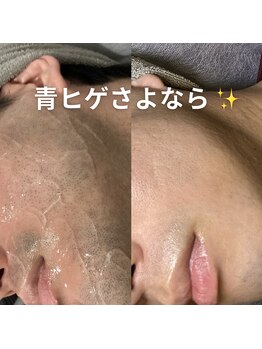 アムリリー 南草津店(AMRILY)/メンズ脱毛