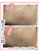 サロンシャイン(Salon Shine)/ハーバルピールレベル4