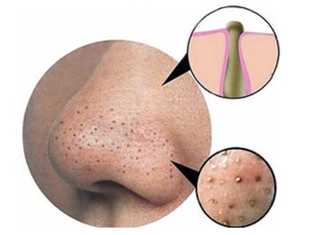 ミント/毛穴の深さ知ってる？５ｍｍです