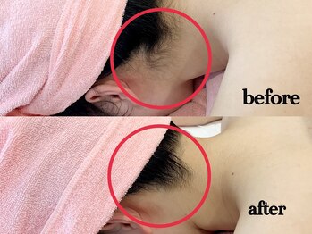 シルク(Cilk)/うなじ脱毛