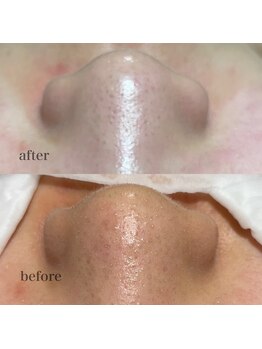 シャルム ド ケー(charme de k)/最強毛穴洗浄