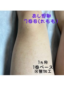 フェリッセ(FELISSE)/あし脱毛 照射7回目【M様】