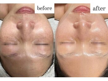 ビー ブルーム(B BLOOM)/【プラズマミケア】シミくすみに