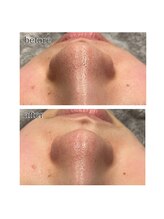 アデル 久留米(ADEL)/フェイシャルワックス