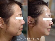 ティアス(t-us)/【真皮】水光肌ACトリートメント