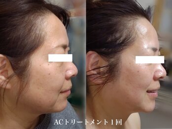 ティアス(t-us)/【真皮】水光肌ACトリートメント