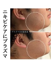 トリニティスペース(TrinitySpace)/ニキビケア、跡も滑らかプラズマ