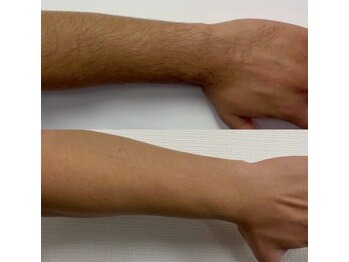 オーシャンブルー 長崎店(OCEAN BLUE)/メンズ脱毛