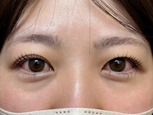 エイジレス(AGELESS)/ポイント→目の左右差改善