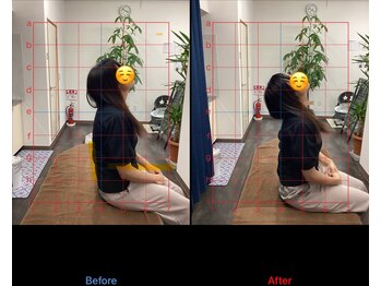 北春日部接骨院/首　ビフォーアフター