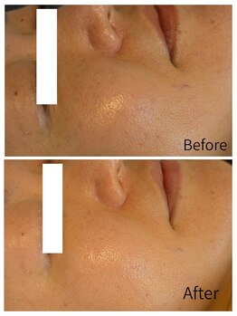 ラオン(laon)/イルミネーティングコース