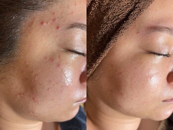 サロン ド エン(Salon de. en)/輪郭もスッキリハーブピーリング