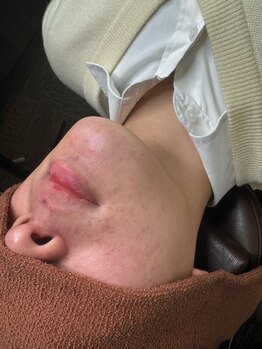 プルメリア(Plumeria)/髭が無くなって清潔感UP!