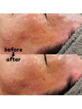 ミア(Mia)/あとぴーですが保湿でツルン♪